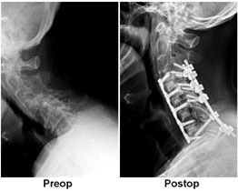 before and after picture of neck surgery